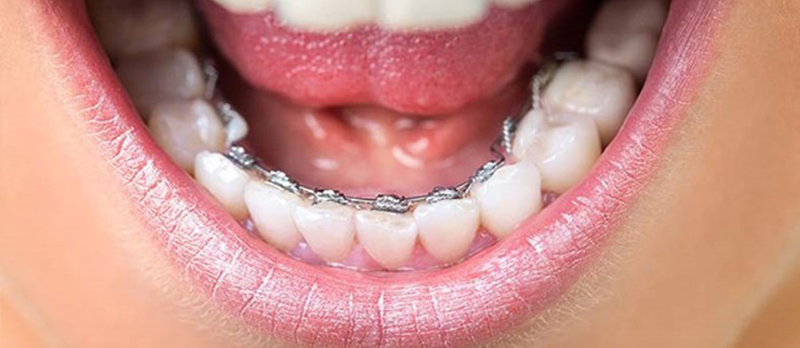 nieng-rang-mac-cai-mat-trong