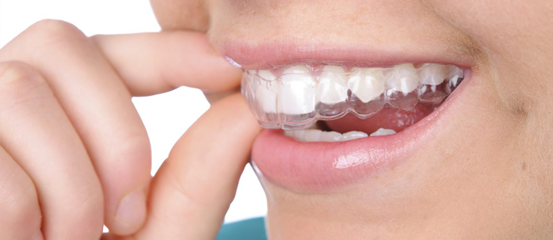 nieng-rang-trong-suot-invisalign