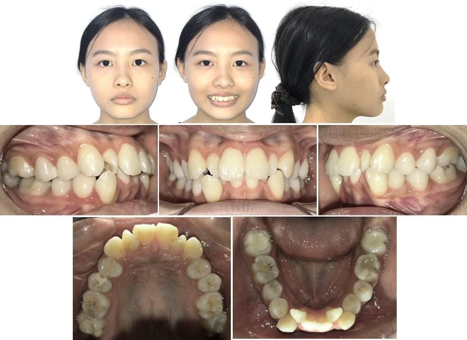Các Case Niềng Điển Hình Tại Uni Dental