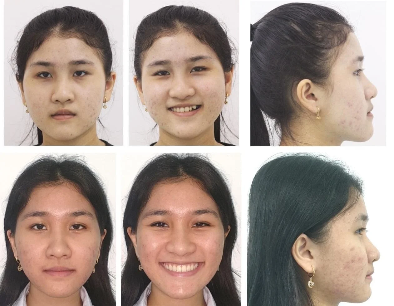 Tại Sao Mặt Lại Lệch? Niềng Răng Có Hết Được Không?