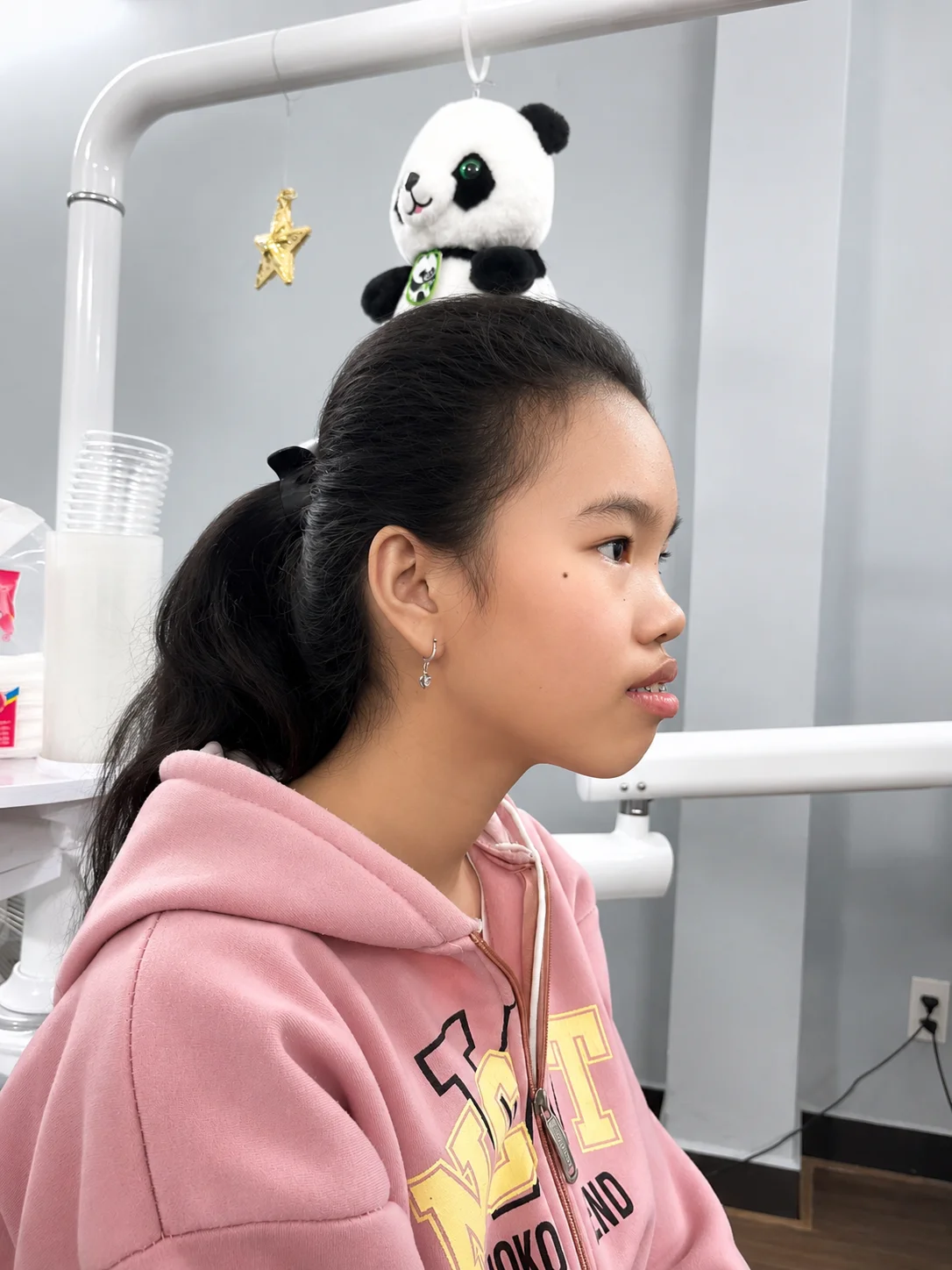Case niềng răng giảm hô tại Uni Dental