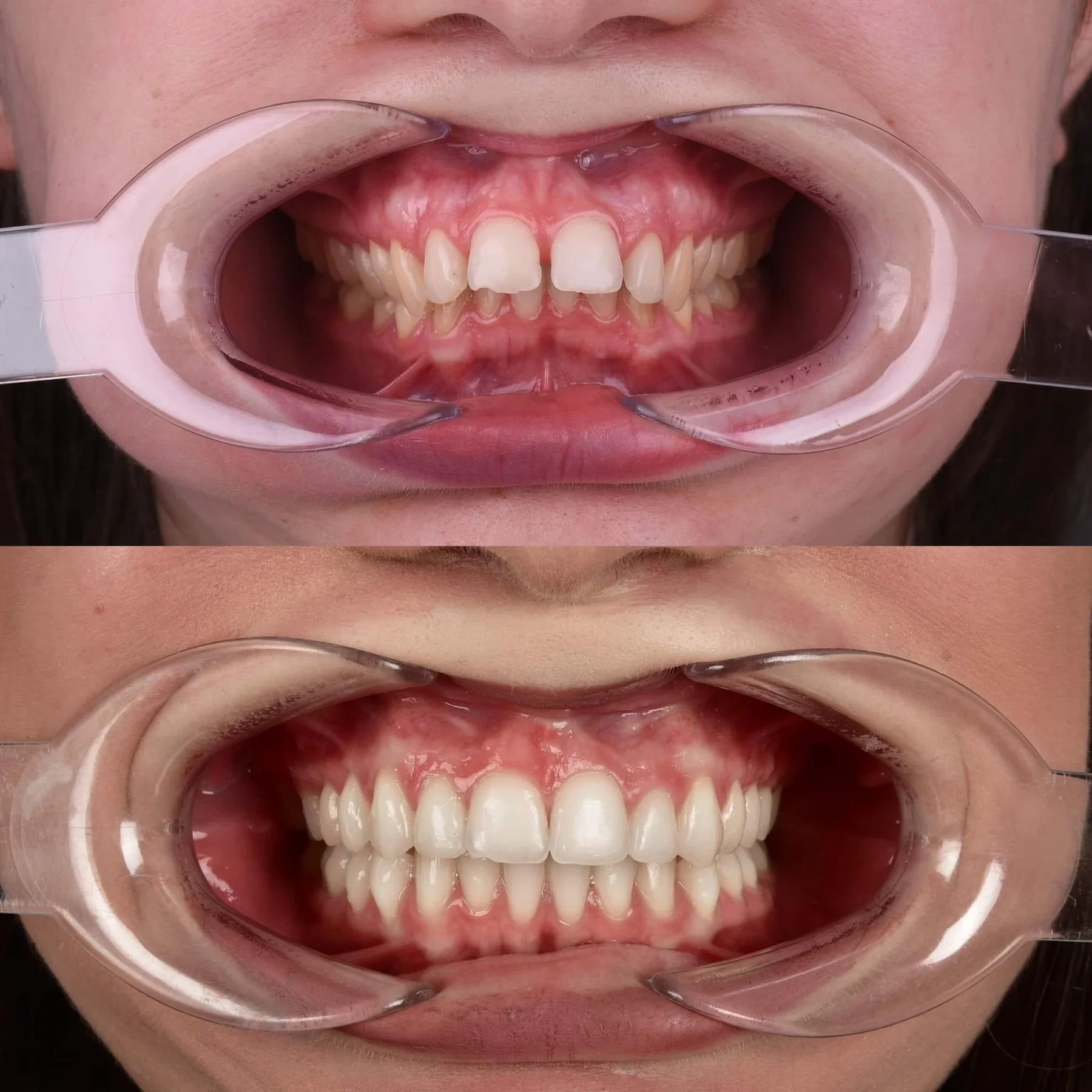 Các Case Niềng Điển Hình Tại Uni Dental