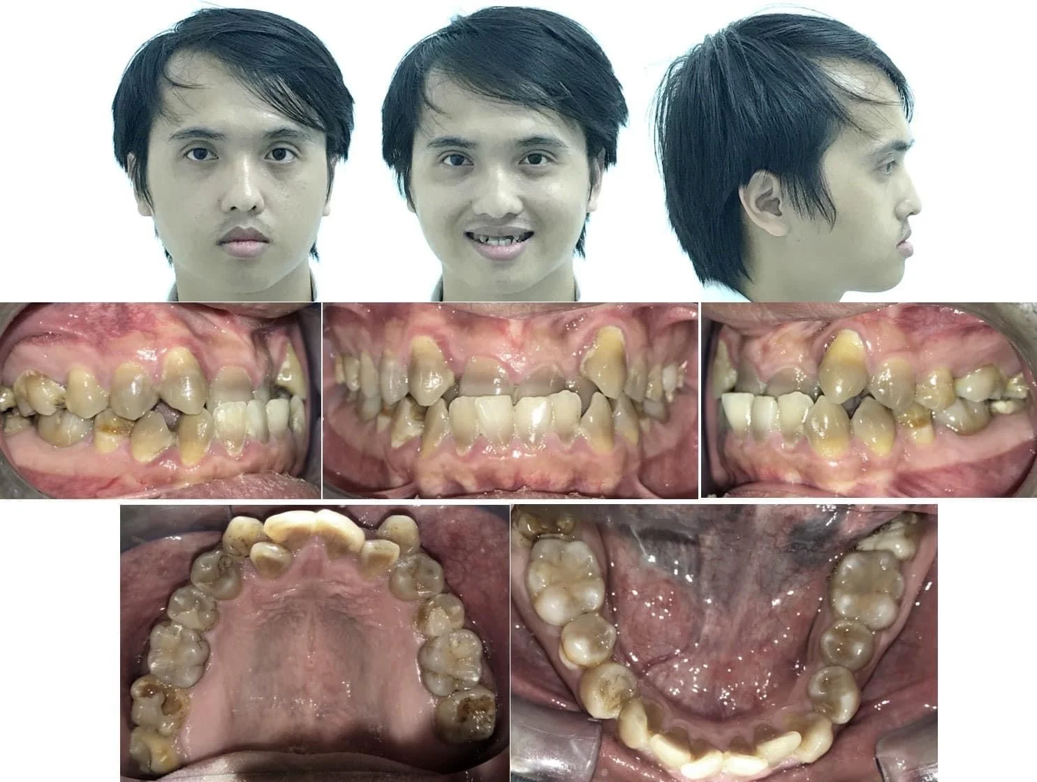 Các Case Niềng Điển Hình Tại Uni Dental