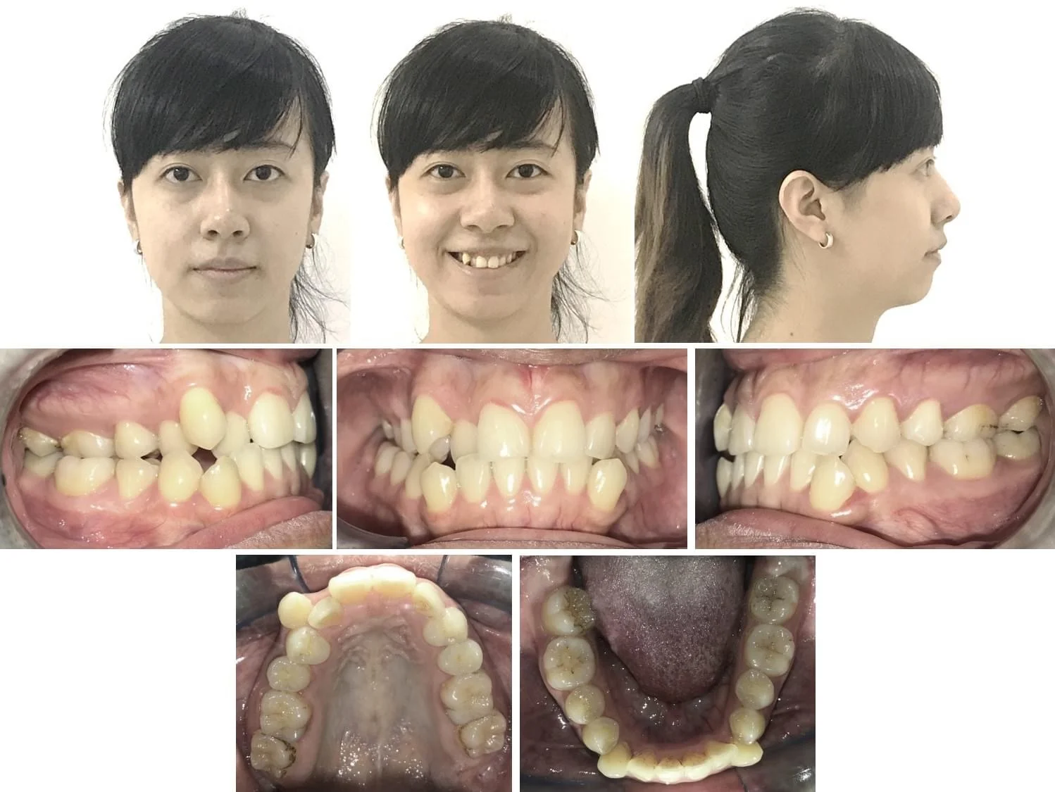 Tại Sao Mặt Lại Lệch? Niềng Răng Có Hết Được Không?