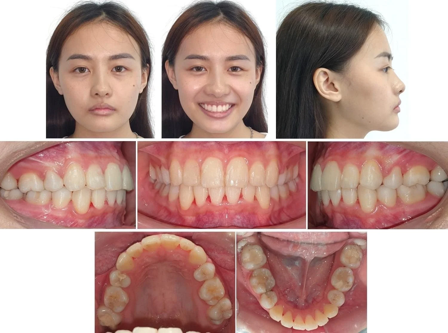 Các Case Niềng Điển Hình Tại Uni Dental