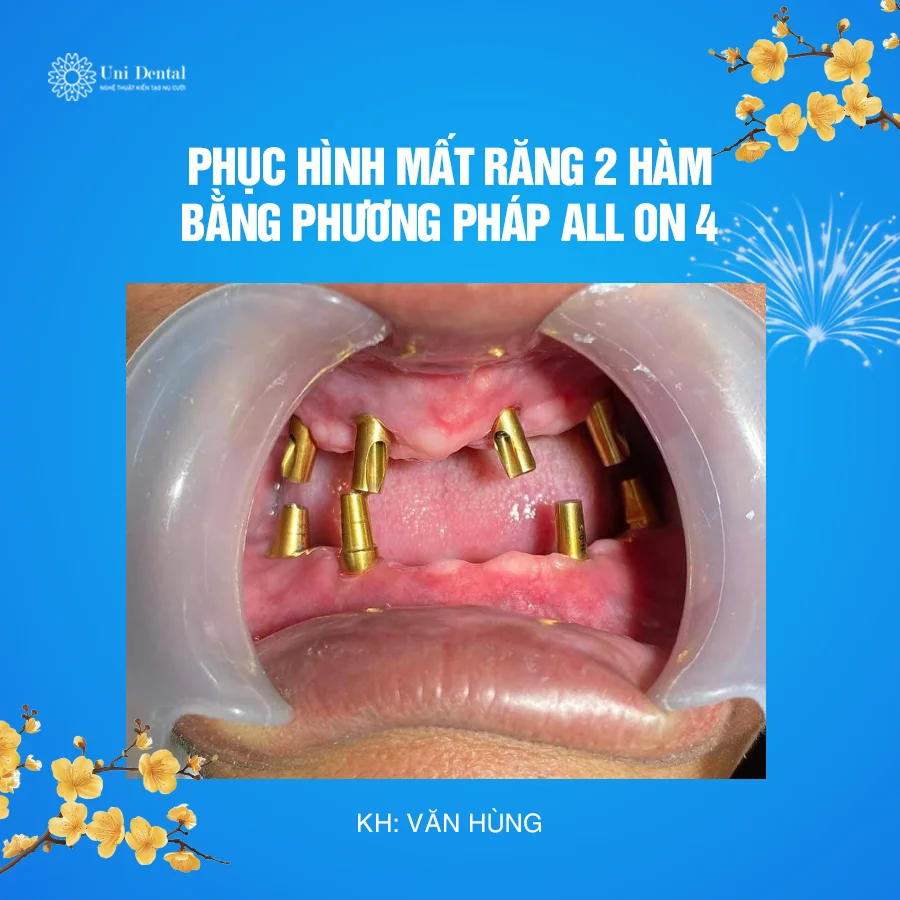 Trồng Răng Implant Toàn Hàm All-on-4 or 6