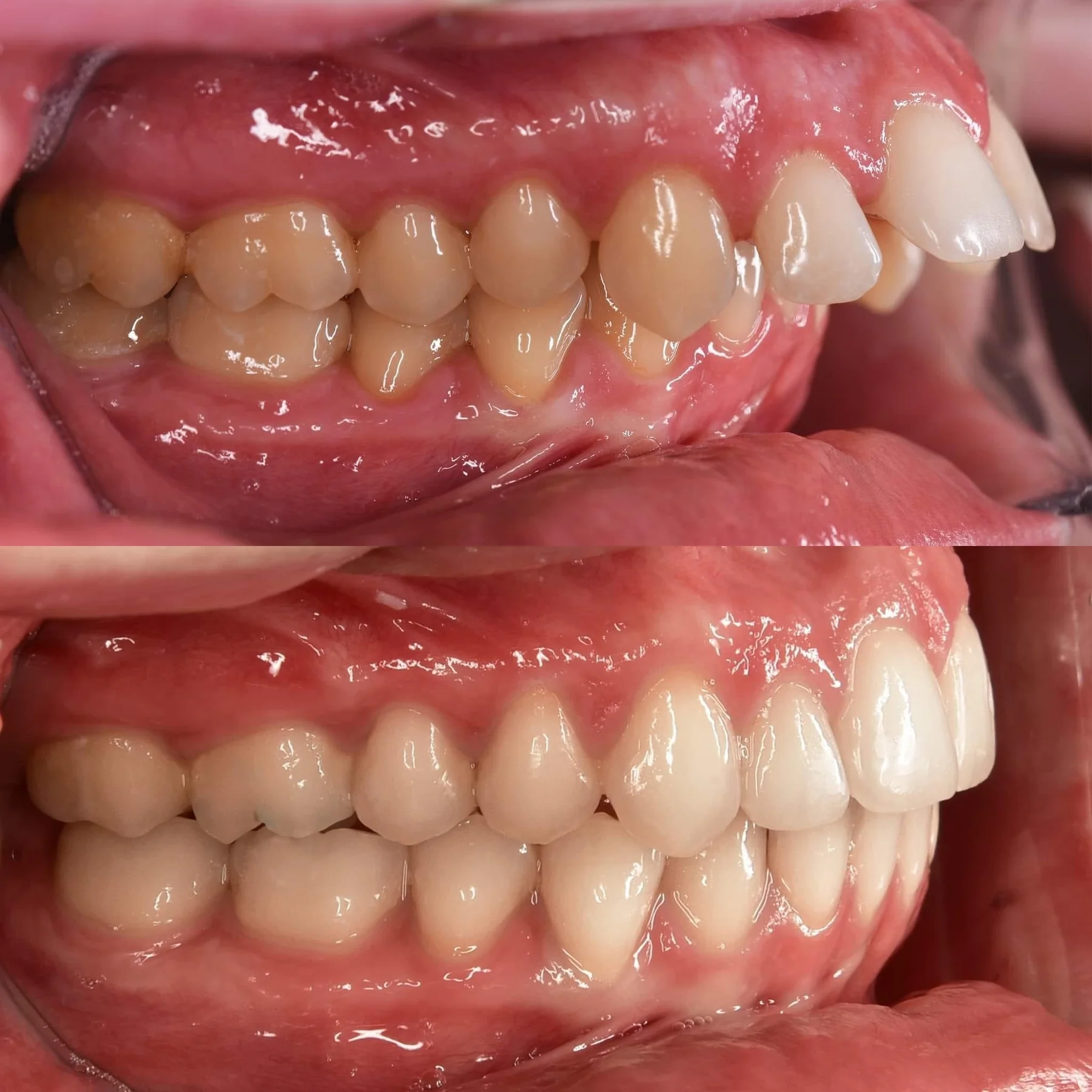 Các Case Niềng Điển Hình Tại Uni Dental