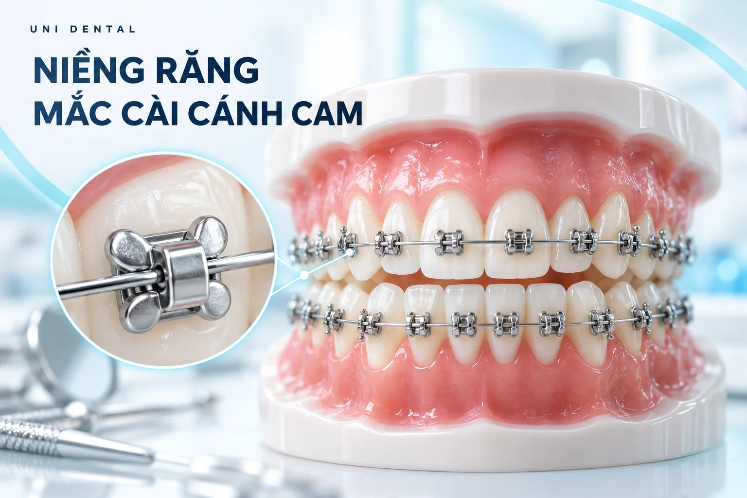 Niềng Răng Mắc Cài Cánh Cam