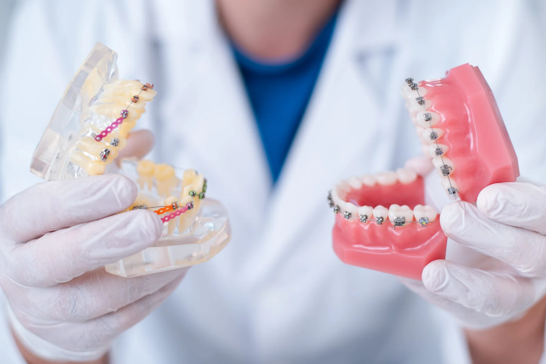 Nên chọn mắc cài nào để chỉnh nha?