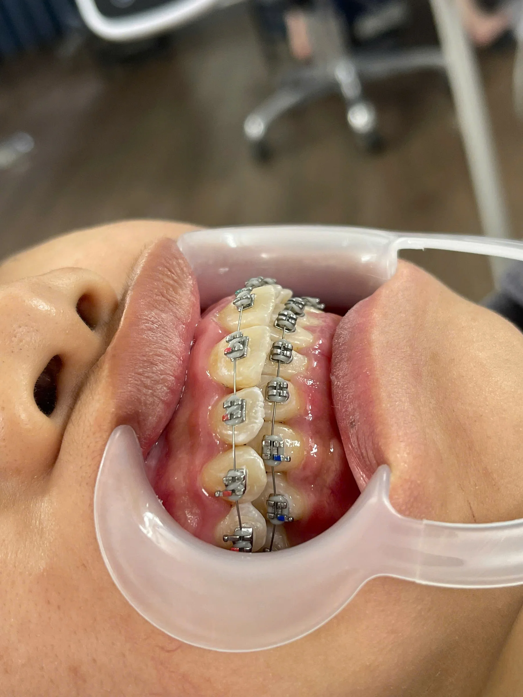 Case niềng răng giảm hô tại Uni Dental