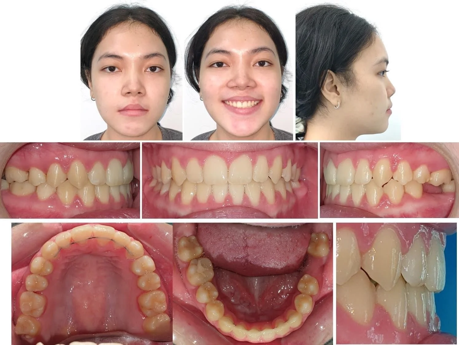 Các Case Niềng Điển Hình Tại Uni Dental