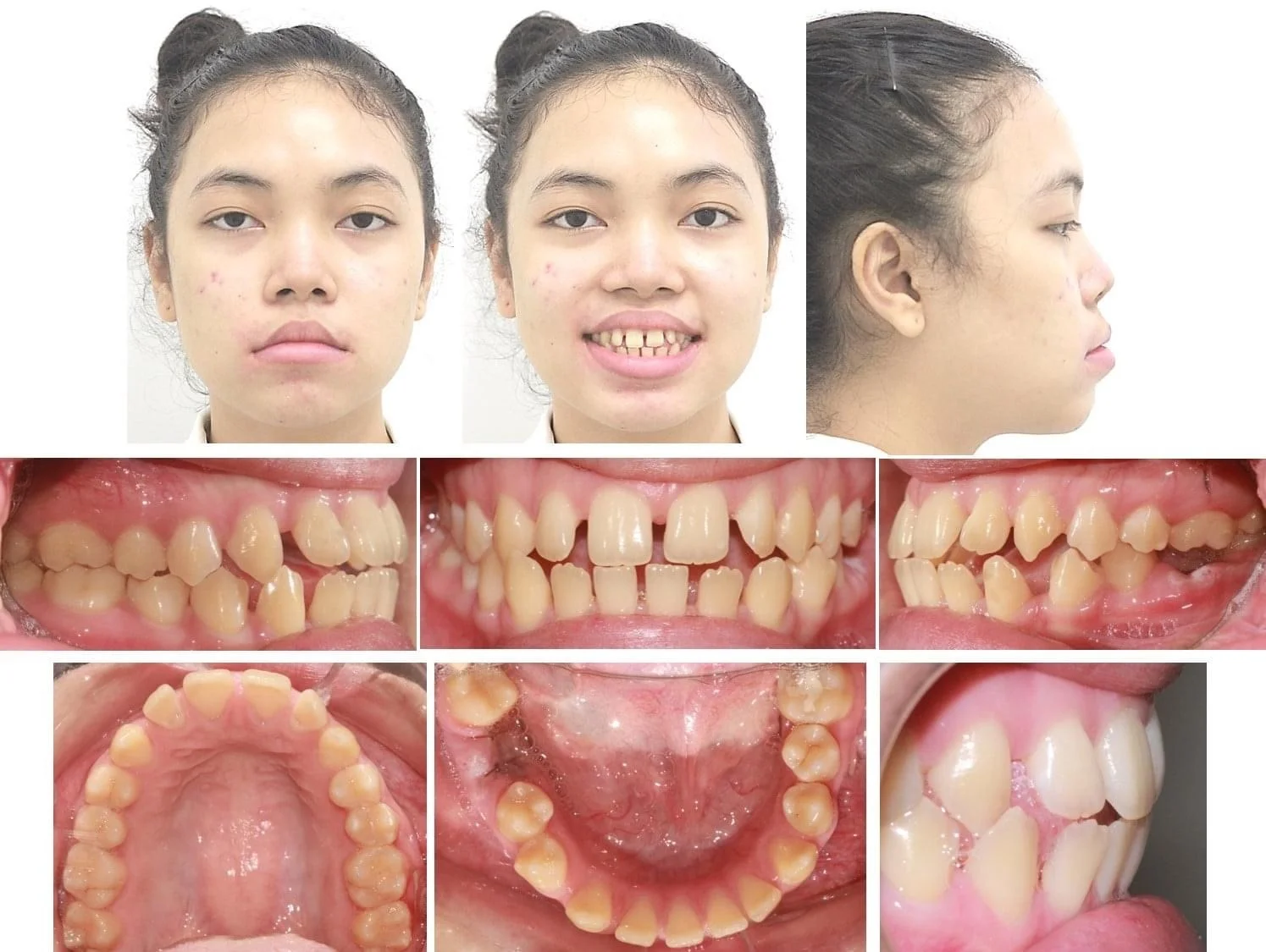 Các Case Niềng Điển Hình Tại Uni Dental