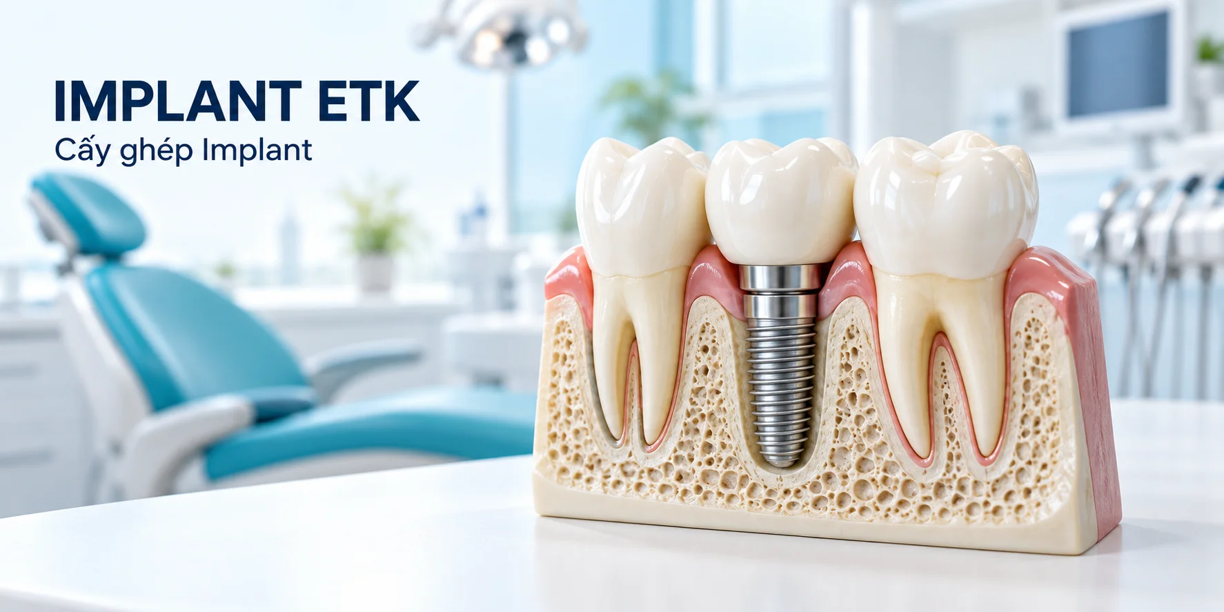 Implant ETK Pháp